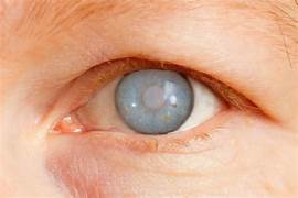 Glaucoma: 8 mitos e verdades que você precisa saber 1 Olhos afetados pelo Glaucoma Divulgacao Internet