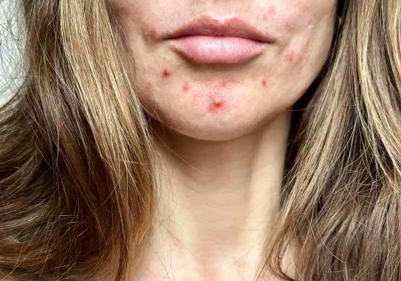 Mulher com espinhas no rosto Divulgacao